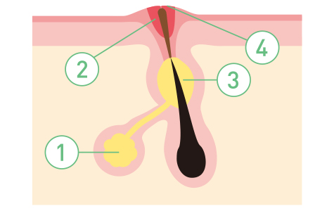 毛穴の詰まりからニキビが発生